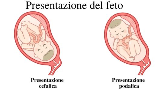 Presentazione podalica