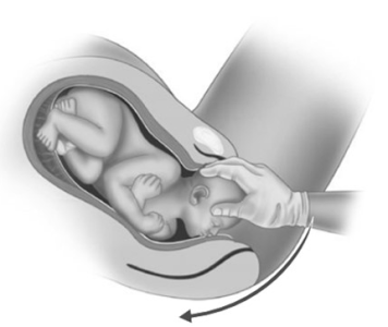 Manovra di Zavanelli - distocia di spalla