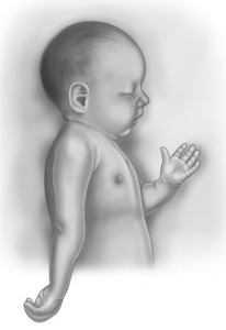 Paralisi neonatale del plesso brachiale