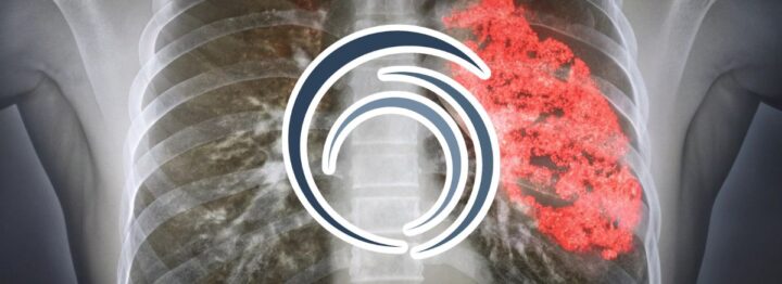 Morte da polmonite ab ingestis per responsabilità medica